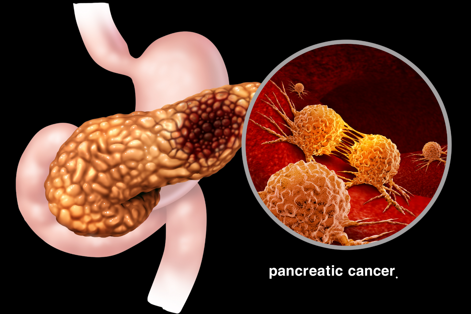 pancreatic cancer.